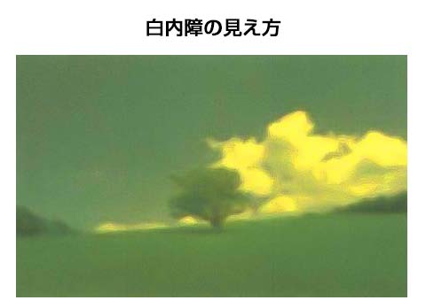 白内障の見え方